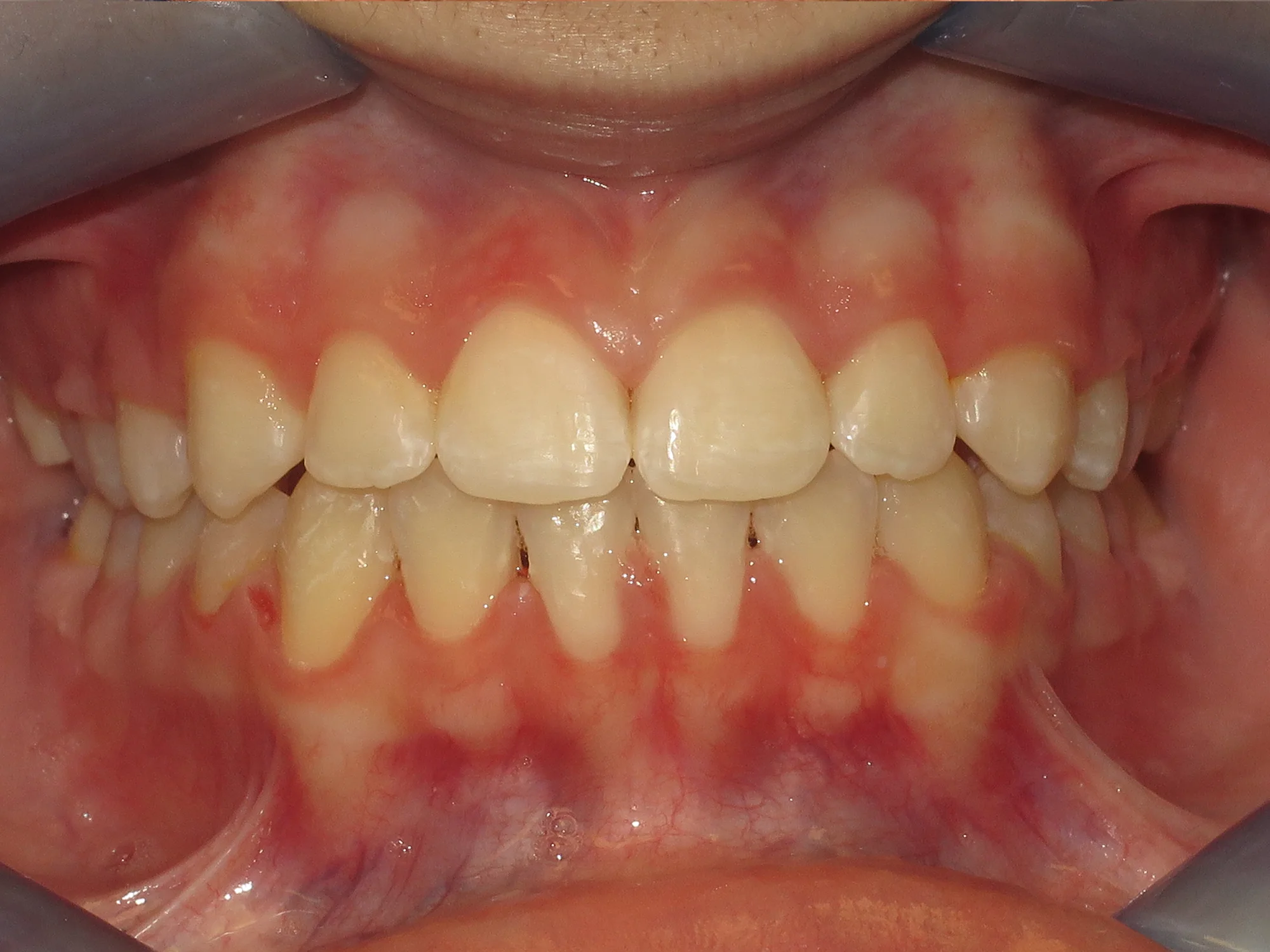 Lower teeth perfectly straight and evenly spaced after braces.