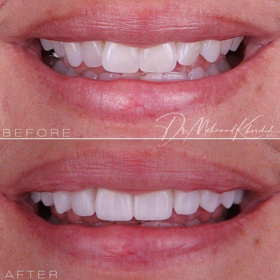 Before and after smile transformation