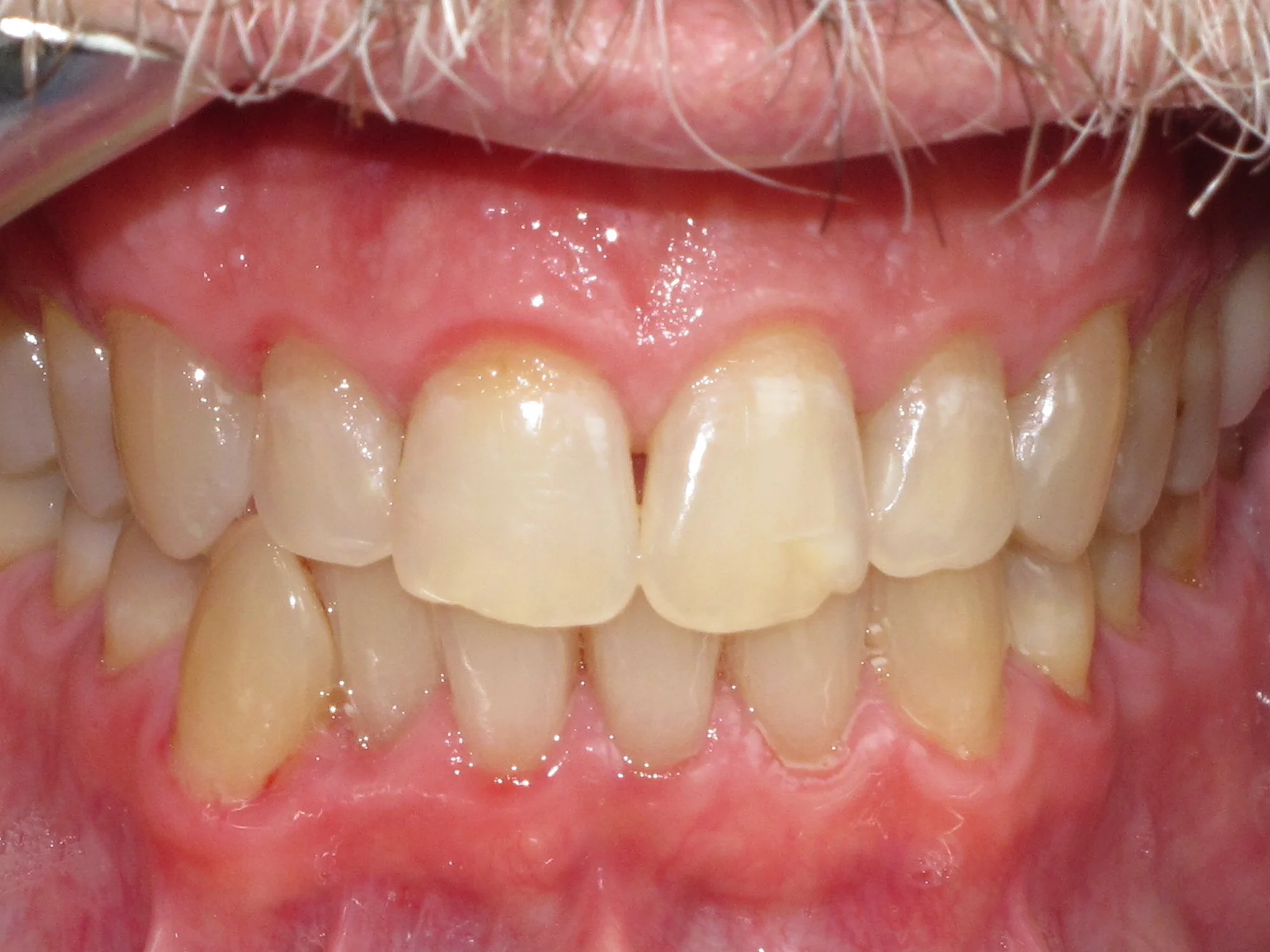 Lower front tooth sticking out of alignment, and upper teeth misaligned before Invisalign
