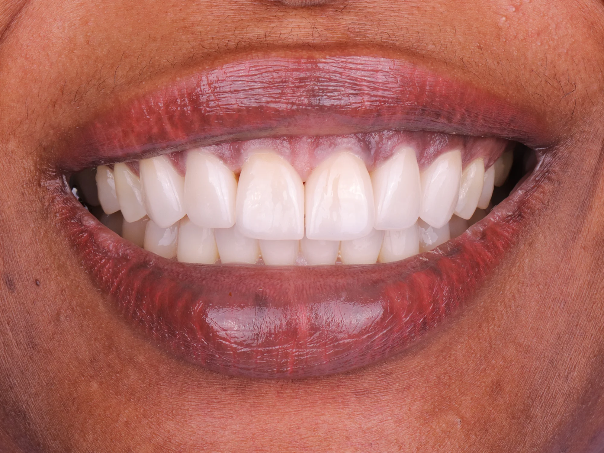 Aligned front teeth after porcelain veneers with no visible gap.