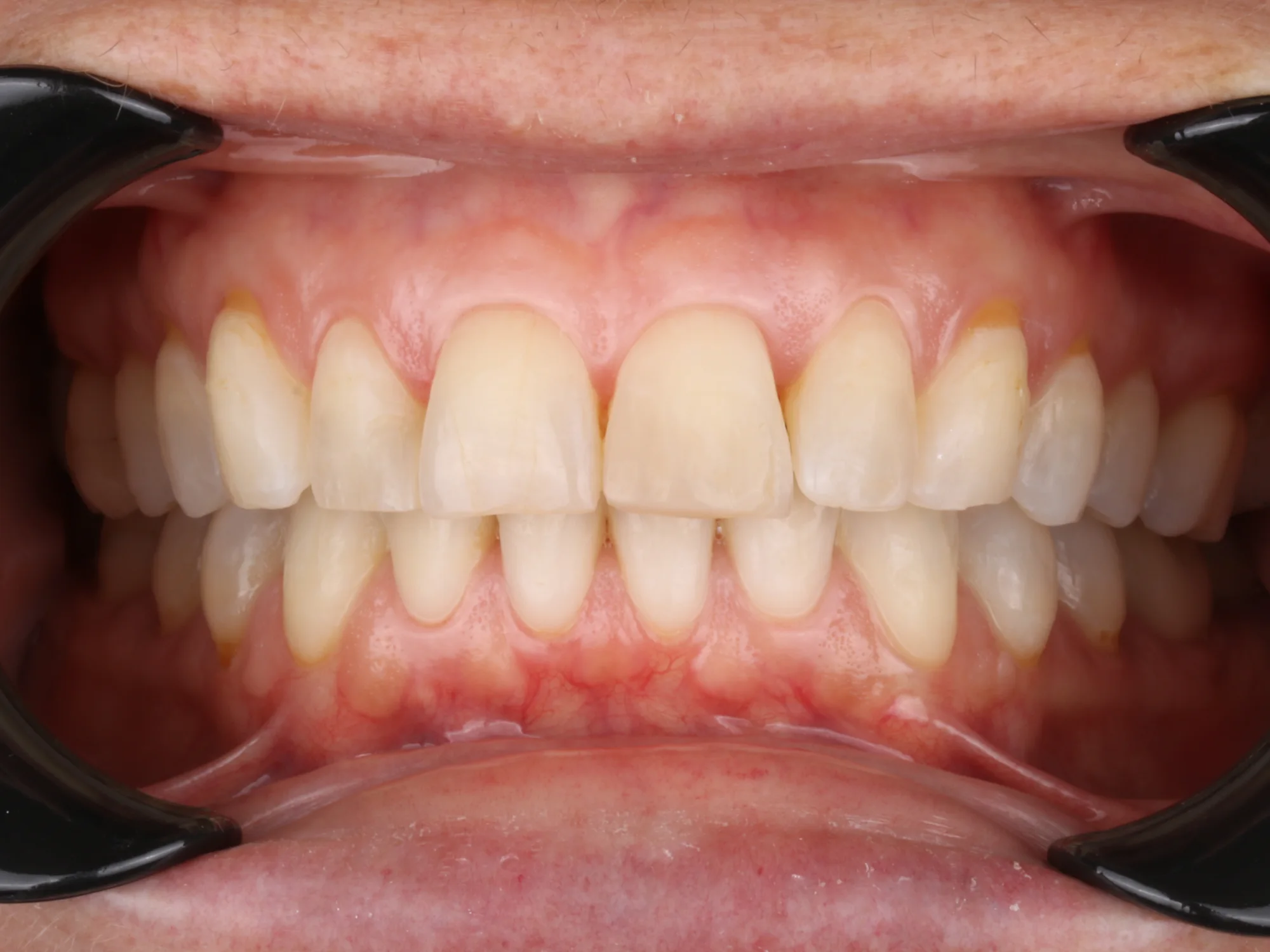 Dull, discolored teeth with no shine before porcelain veneers