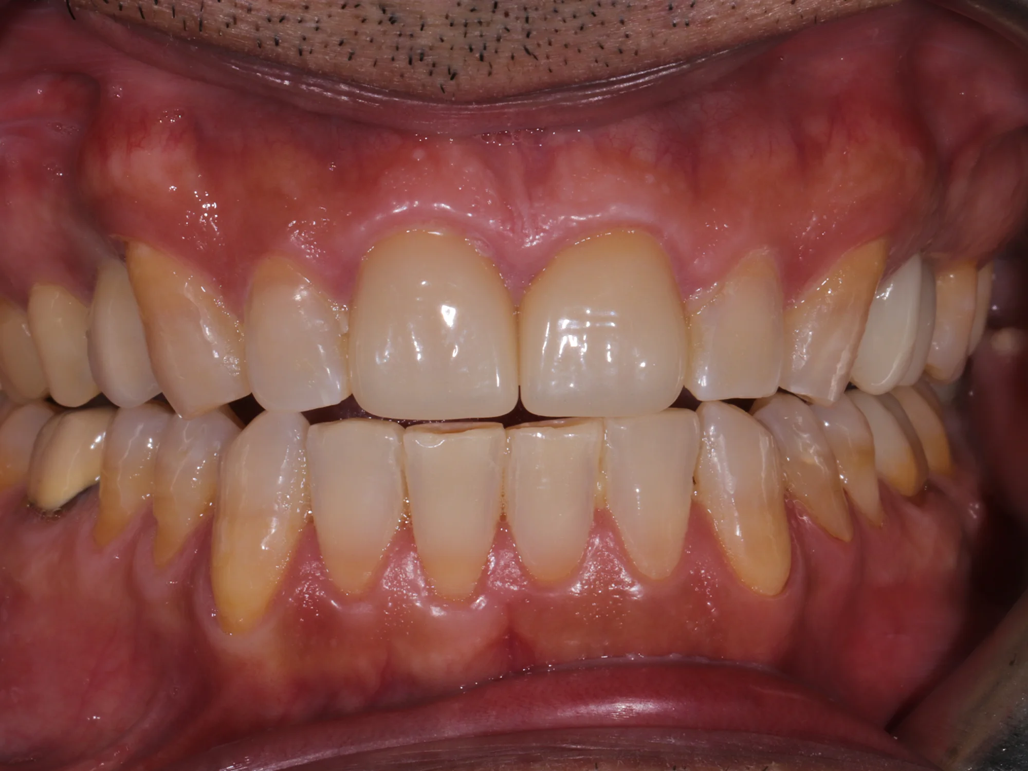 Close-up of a front tooth after receiving a Same-Day Crown Veneer at Mississauga Dentistry