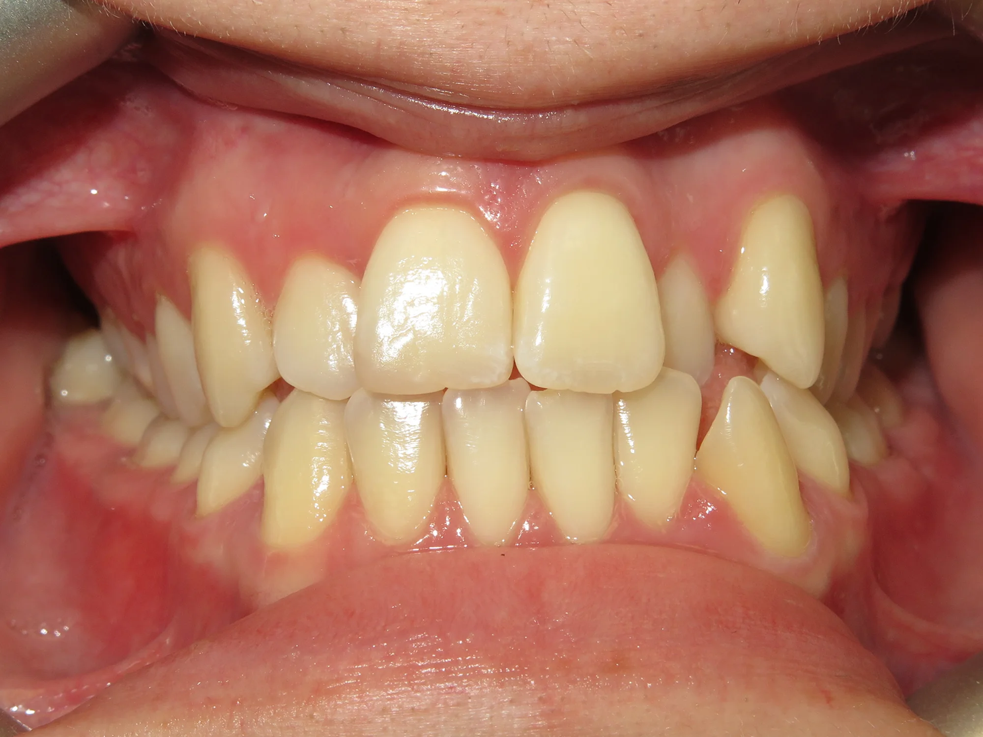 Crowded lower teeth and uneven upper teeth before orthodontic treatment