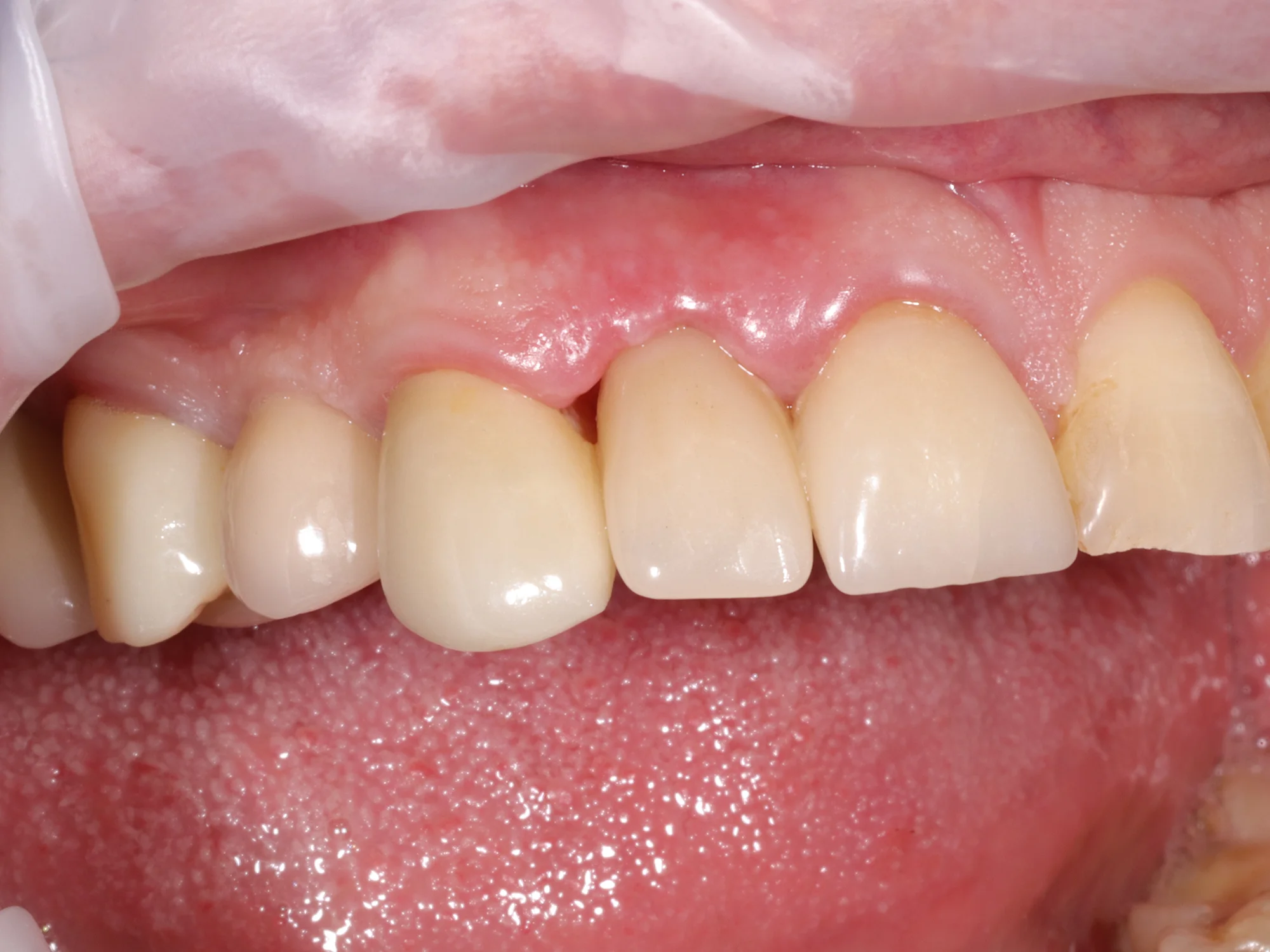 Front tooth restored with same-day crown at Mississauga Smiles Dentistry.