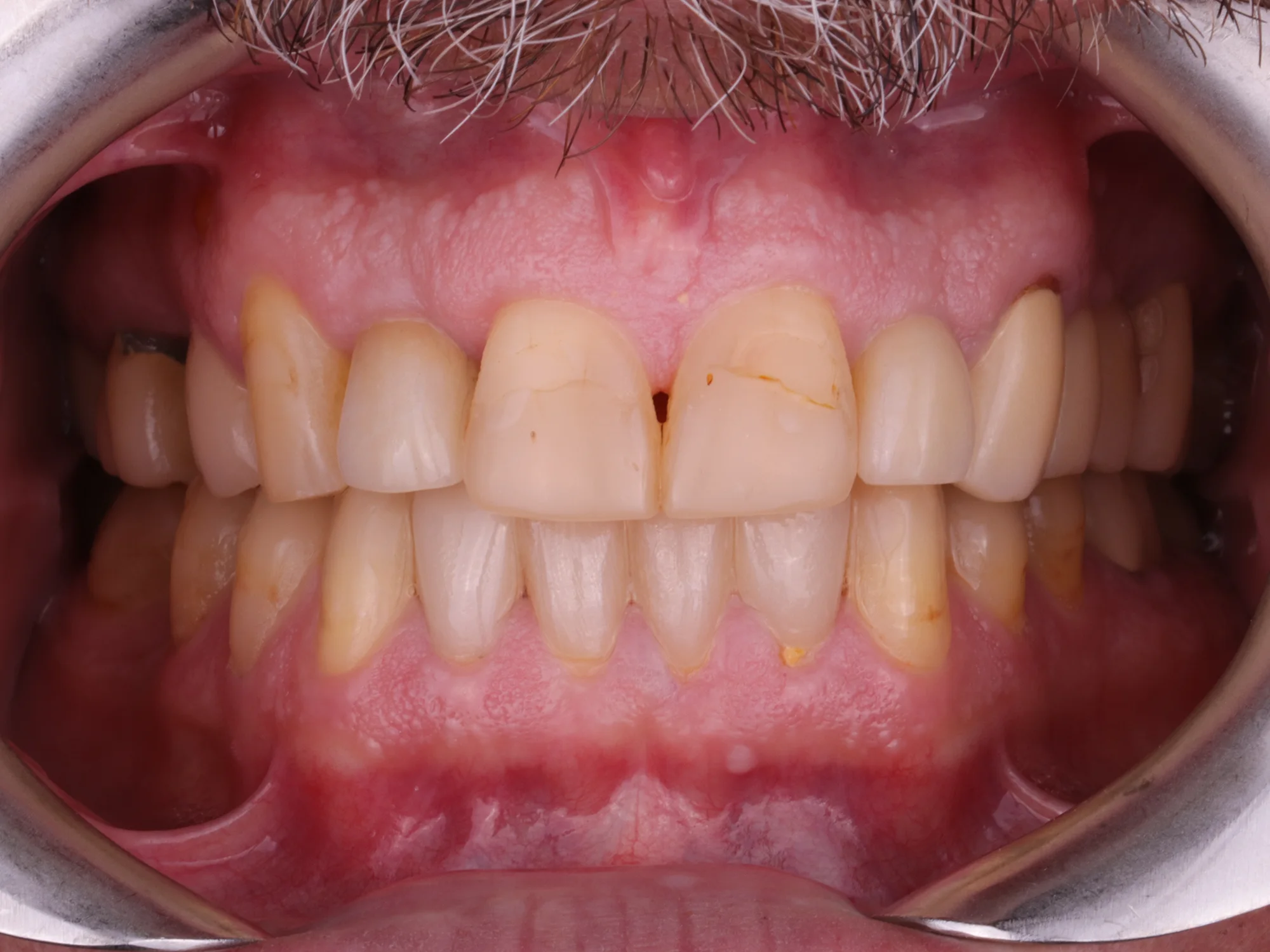 Teeth before veneers or crowns showing discoloration and minor misalignment.