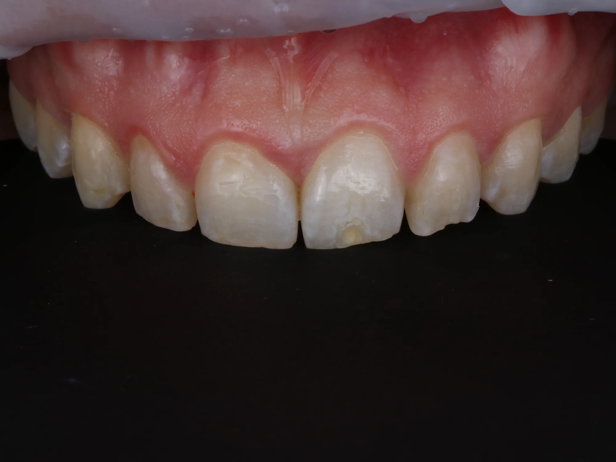 Close-up of upper front teeth with discoloration, enamel wear, and minor chipping