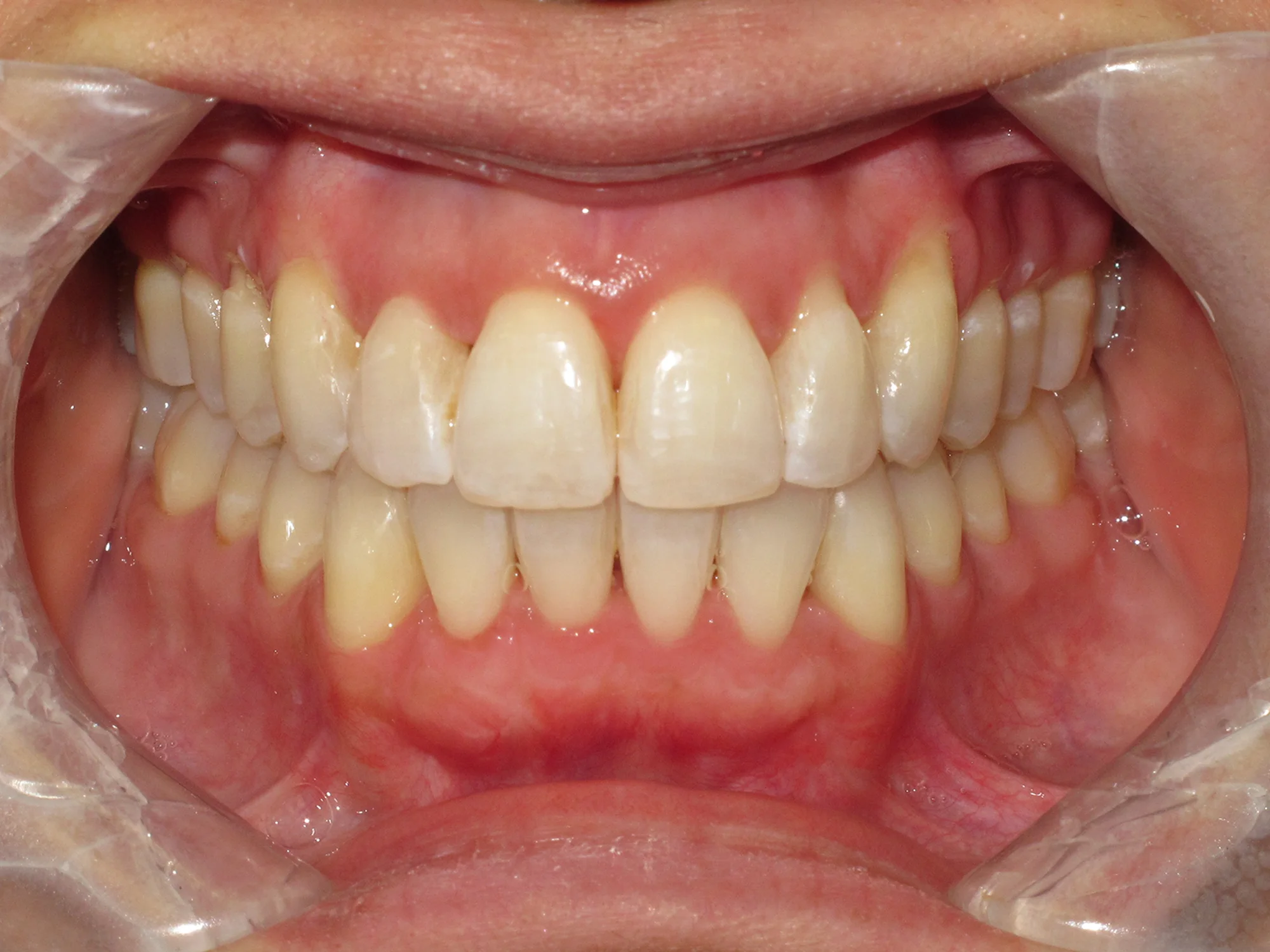 Upper and lower teeth in perfect alignment after Invisalign treatment