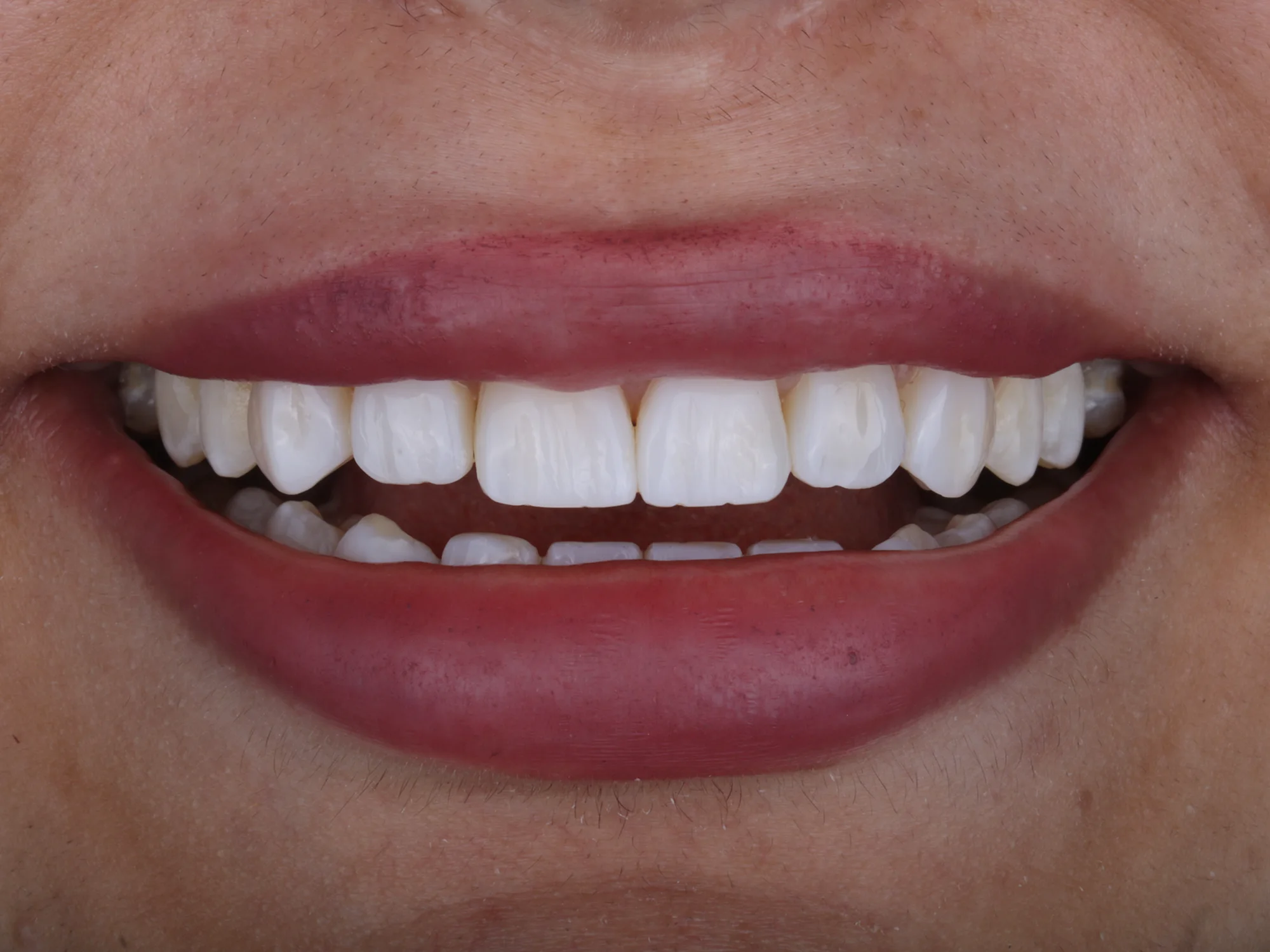 Teeth perfectly aligned after smile makeover treatment, with no gaps.