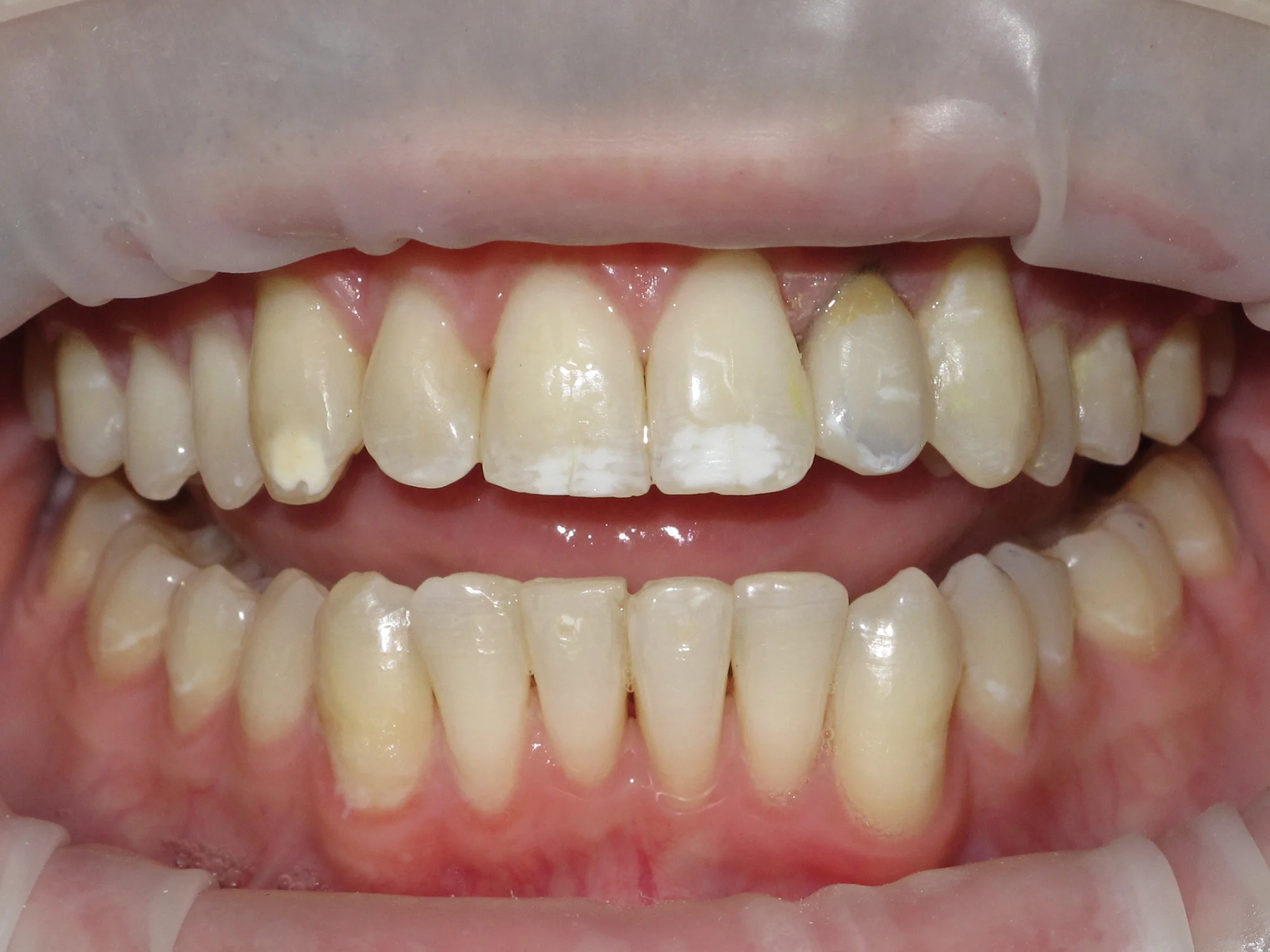 Close-up of aligned upper and lower teeth after Invisalign treatment at Mississauga Smiles.
