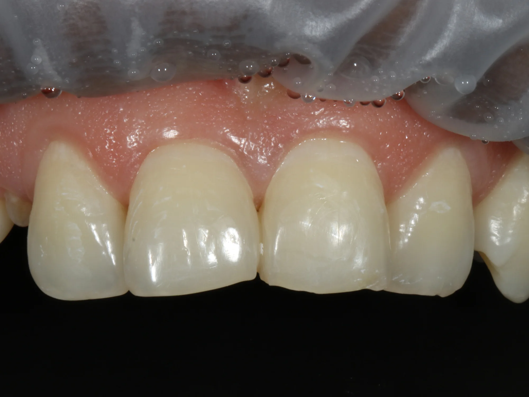 Close-up of upper front teeth with uneven edges and before a smile makeover treatment.