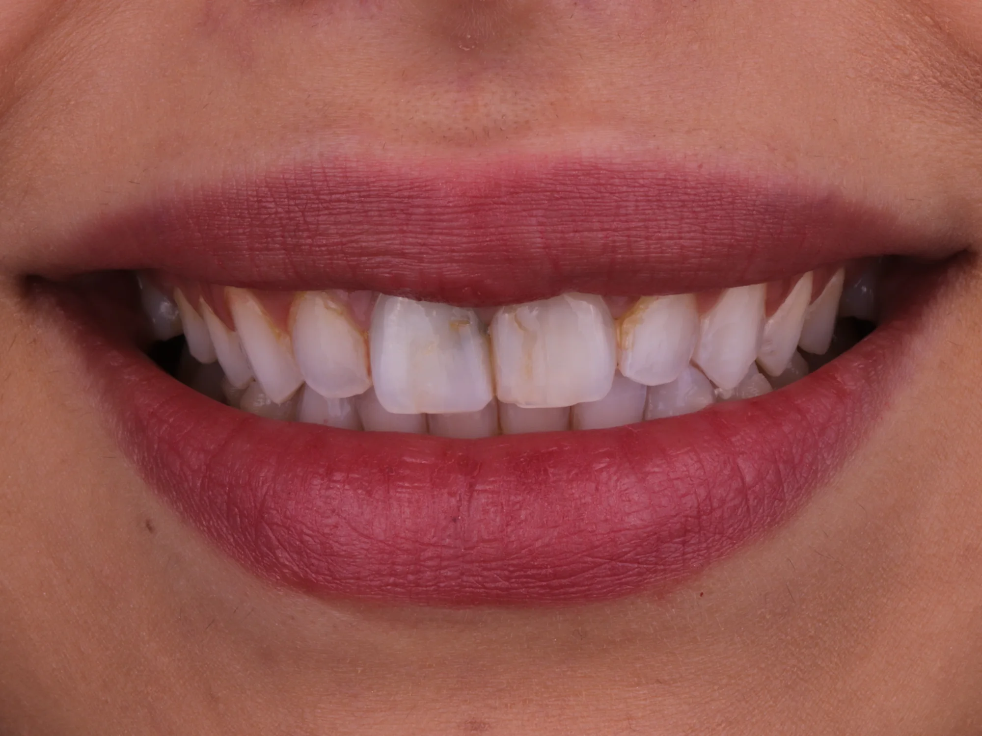 Close-up of upper front teeth showing discoloration and damage before porcelain veneer