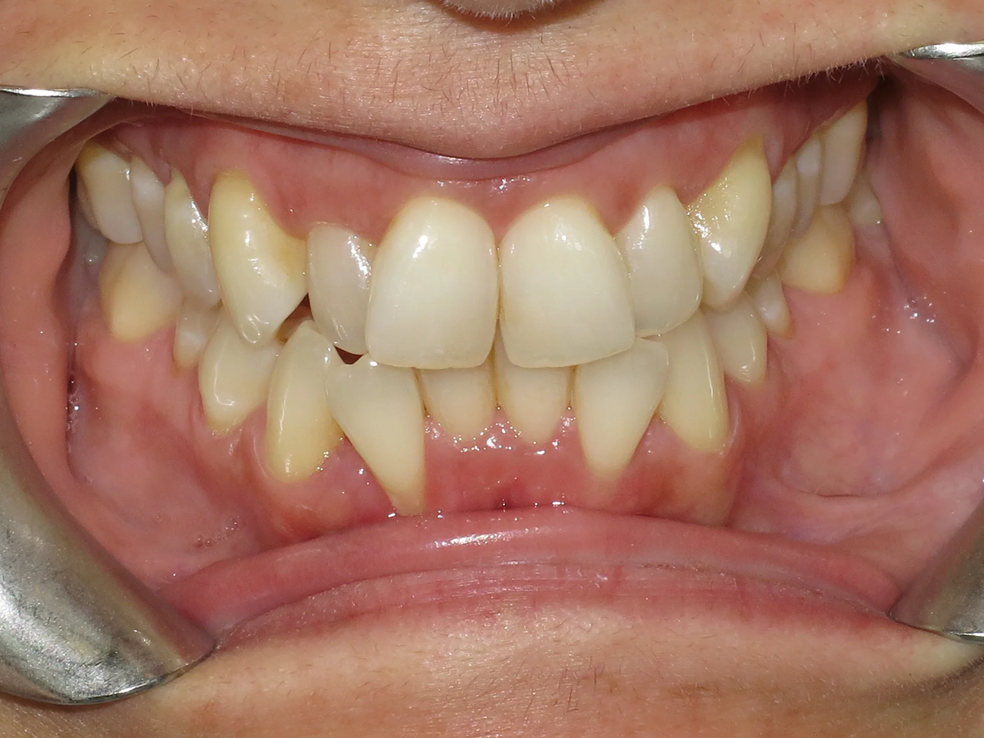 Upper and lower teeth showing disalignment and crowding before Invisalign treatment.