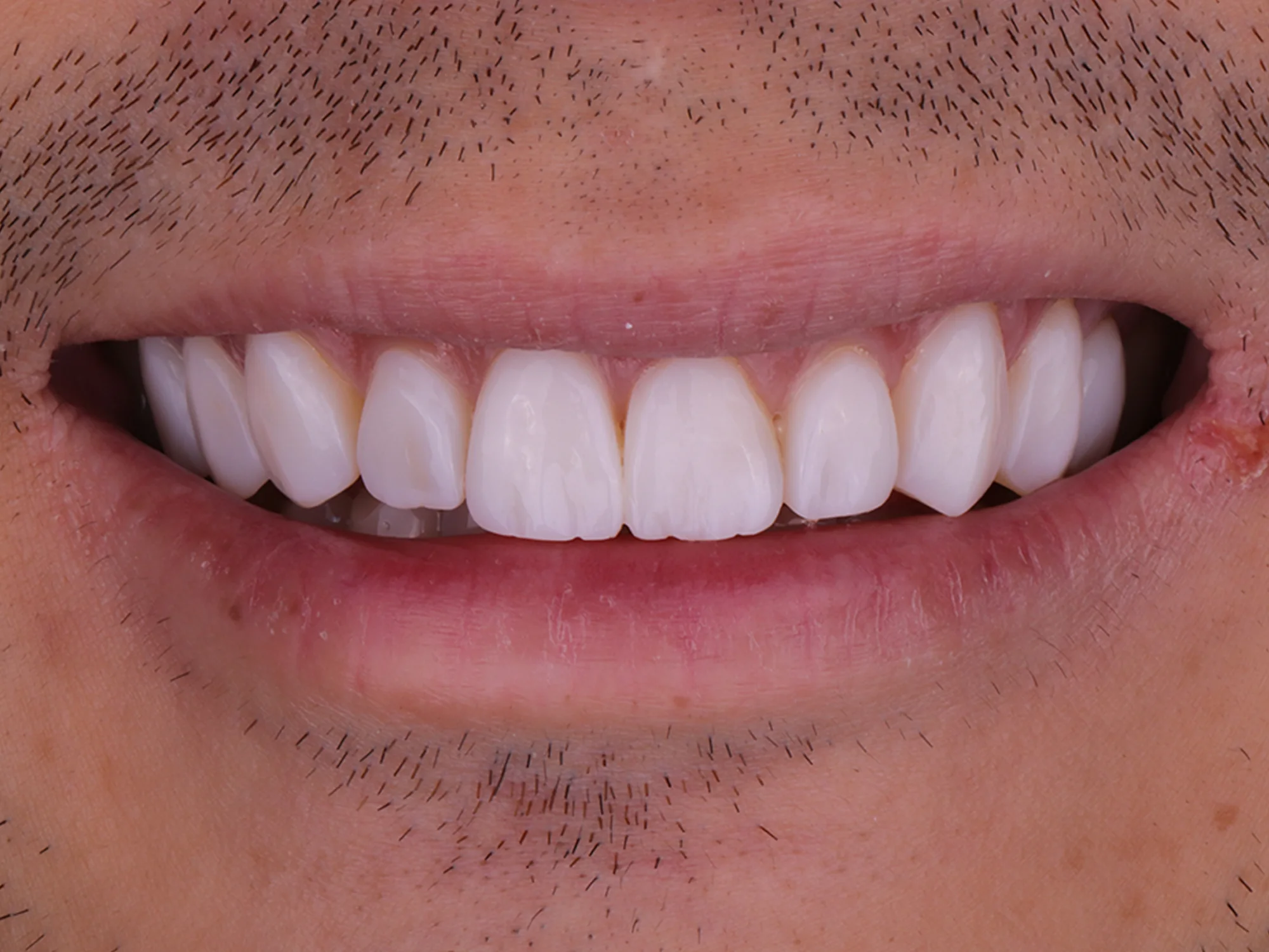 Close-up of a perfectly aligned, bright, and natural-looking smile after smile makeover.