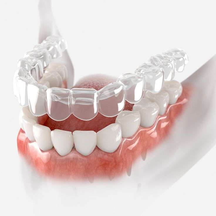 Clear aligners on teeth for orthodontic treatment illustration.